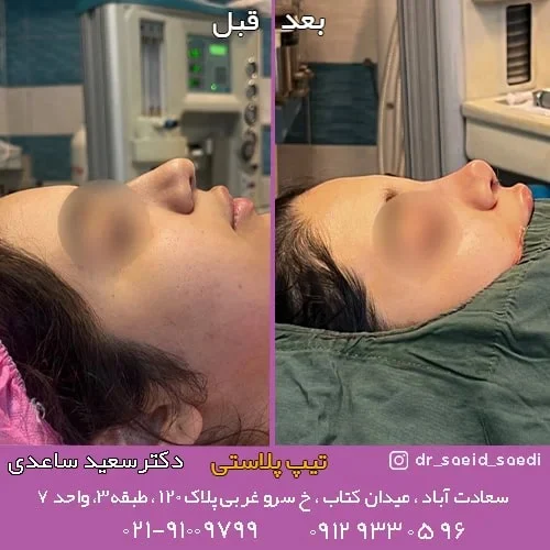 عمل تیپ پلاستی بینی