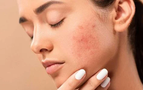 راه های از بین بردن جای جوش