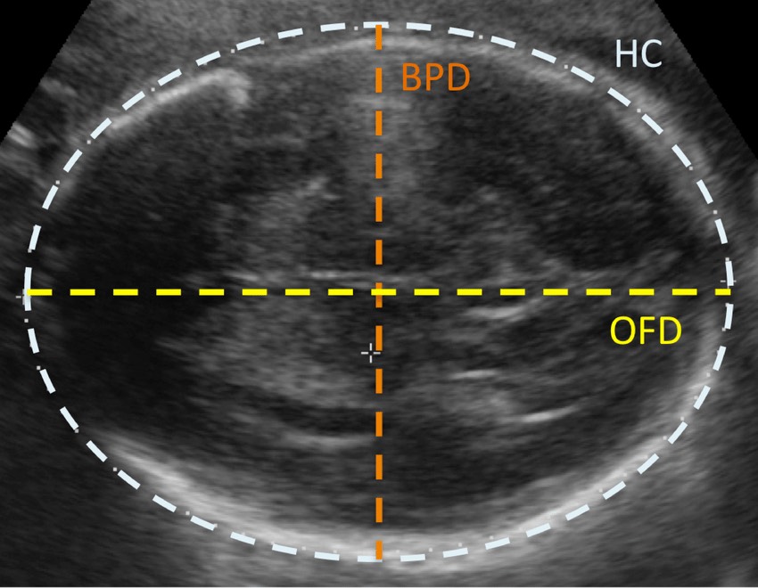 BPD در سونوگرافی چیست و اندازه گیری BPD چه معنایی دارد؟