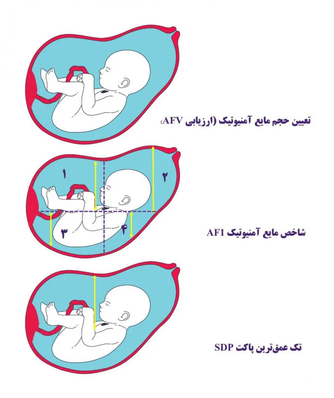 حجم مایع آمنیوتیک در طول بارداری