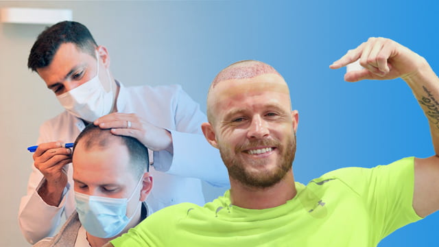 بعد از کاشت مو تا چند روز باید به حالت نشسته بخوابیم؟