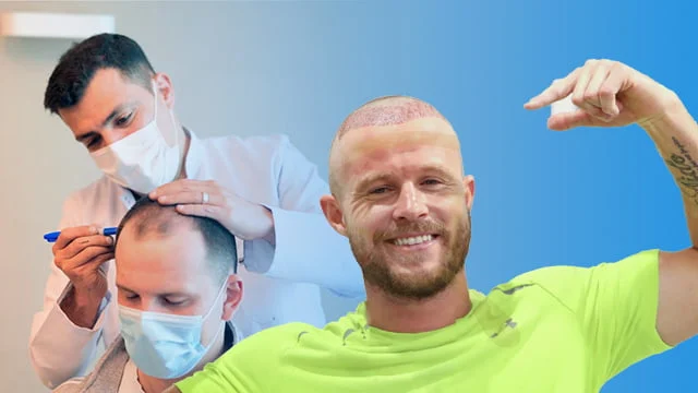 بعد از کاشت مو تا چند روز باید به حالت نشسته بخوابیم؟