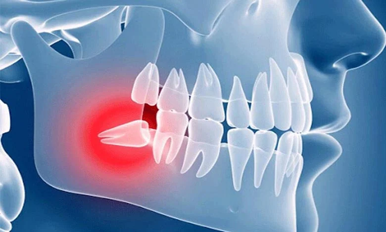 دندان عقل چند سالگی در میاد